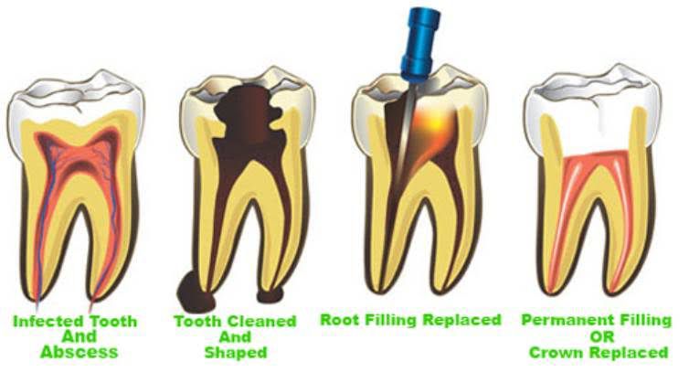 painless dental implant in mumbai