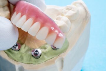 10 Common Myths About Dental Implants Debunked