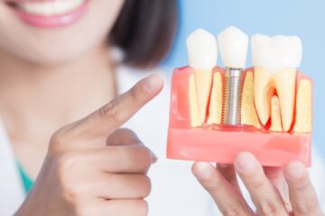 What Are Dental Implants and Why Are They Important for Oral Health?