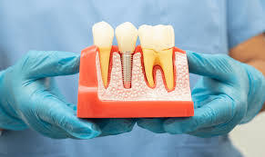 Step-by-Step Guide to the Dental Implant Procedure: What to Expect