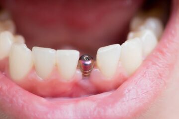 Do Dental Implants Hurt? Everything You Need to Know About Pain in Dental Implants