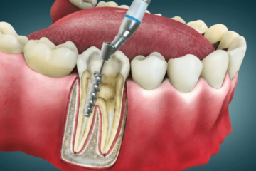 7 Warning Signs You Might Need a Root Canal