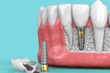 dental implant cost in mumbai