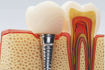 dental implants in mumbai