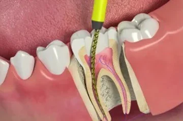 root canal cost in Mumbai