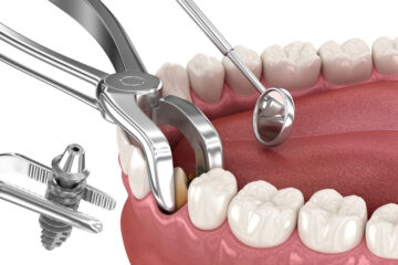 Tooth Implant in Mumbai: Why It’s the Best Solution for Missing Teeth